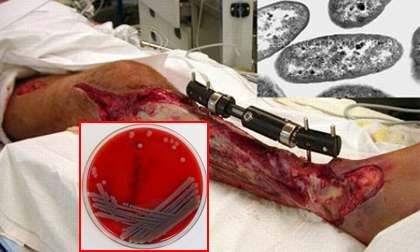 Cận cảnh vi khuẩn ăn thịt người ‘ngấu nghiến’ tế bào