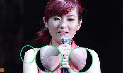 Selina liên tục mặc áo không tay lộ sẹo lớn