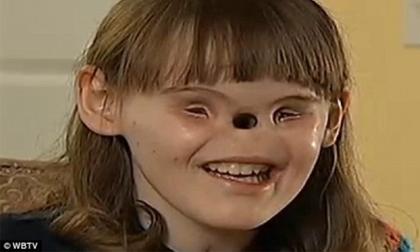 Cô bé 16 tuổi không mắt, không mũi đáng thương