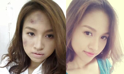 Thanh Vân Hugo thâm tím mặt mày vì bị đánh ghen?