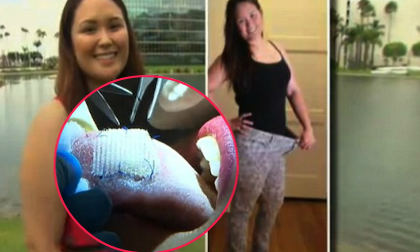 Giảm 10kg nhờ đặt miếng vá "kỳ diệu" vào lưỡi