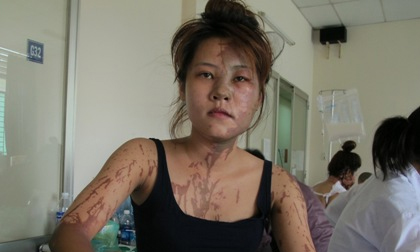 Nữ lễ tân nhà hàng bị tạt axit dã man