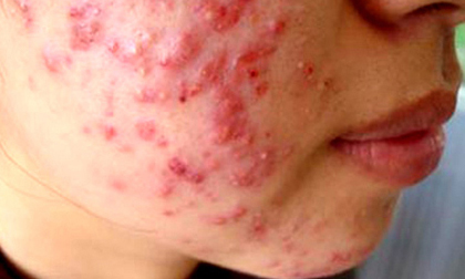 Những hình ảnh ghê rợn từ lột da tắm trắng