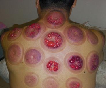 Bị phồng rộp da vì giác hơi quá lâu