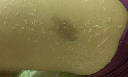 Tắm trắng tại nhà, cô gái bị "lột da" loang lổ toàn thân