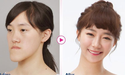 Thiếu nữ Trung Quốc sang tận Hàn để phẫu thuật thành hotgirl