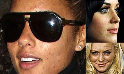 Làn da xấu kinh hoàng của sao