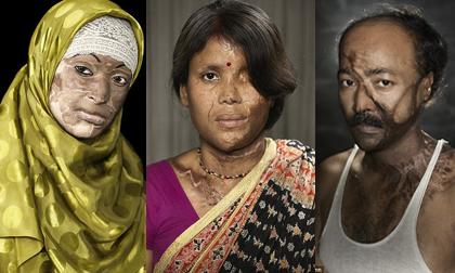 Những khuôn mặt 'biến dạng' bởi bởi axit vẫn lạc quan