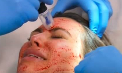 Sự thật về trào lưu làm đẹp bằng... máu tươi