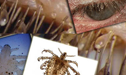 Cảnh báo rận mu tái xuất tại Hà Nội