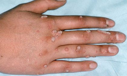 Bệnh mụn cơm: Dấu hiệu nhận biết và cách phòng bệnh