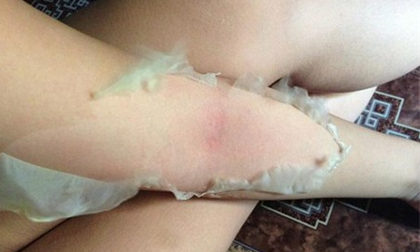 Rùng rợn trào lưu lột da như rắn để làm trắng