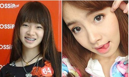 Cận cảnh ca cắt mí của một cô gái