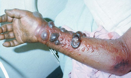 Đại dịch sốt xuất huyết Ebola tấn công cơ thể thế nào?