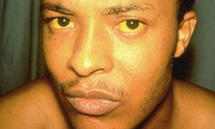 Cách nhận biết ung thư gan đơn giản và sớm nhất