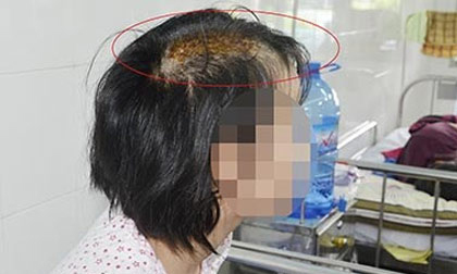 Bé 15 tuổi bị cha dượng chém nứt sọ