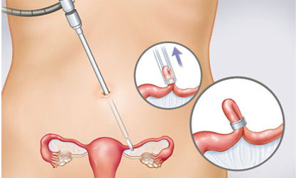 Suýt chết vì quên vòng tránh thai 32 năm trong ổ bụng
