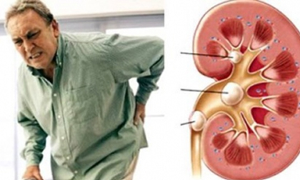 Sỏi thận: Những biến chứng nguy hiểm