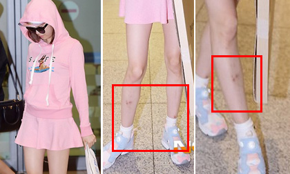 Sao nữ Hàn lộ chân gầy khẳng khiu đầy 'hoa gấm'