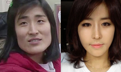 10 ca phẫu thuật thẩm mỹ đáng kinh ngạc nhất xứ Hàn