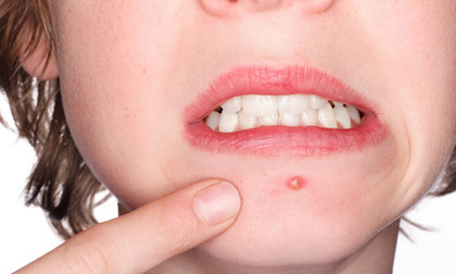 15 vị trí bị mụn nguy hiểm mà nhiều người bỏ qua