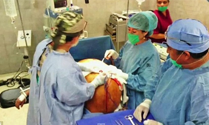 Khối u buồng trứng lớn nhất thế giới, nặng 60kg