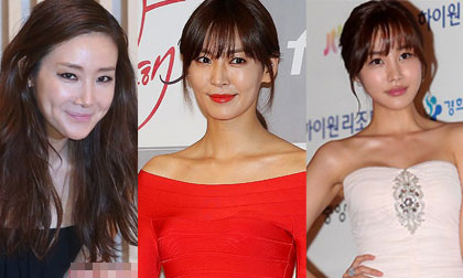 Mỹ nhân Hàn mặt sưng phồng vì phẫu thuật thẩm mỹ