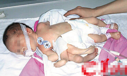 Bé sơ sinh chào đời với 4 tay, 4 chân trên cơ thể