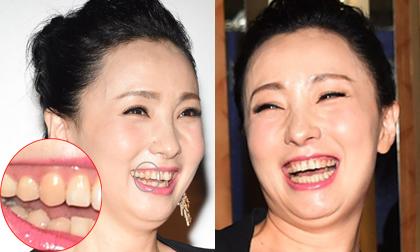 Sao 'Khang Hy vi hành' tái xuất mặt ngấn mỡ, răng ố vàng