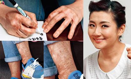 Fan xót xa khi thấy tay và chân biến dạng vì sẹo bỏng của Selina