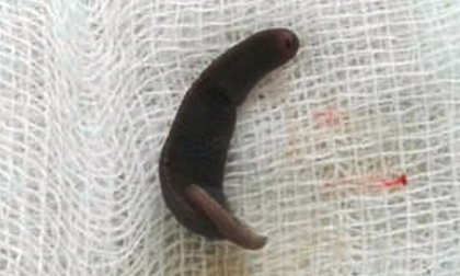 Kinh hoàng, con vắt dài 4cm sống 10 ngày trong mũi cháu bé