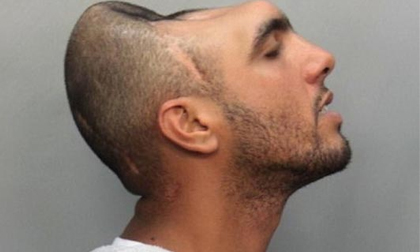 Những 'quái nhân' đầu lõm, móp, mất một nửa