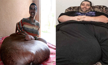 Mắc bệnh lạ, có khối u, tinh hoàn nặng cả trăm kg