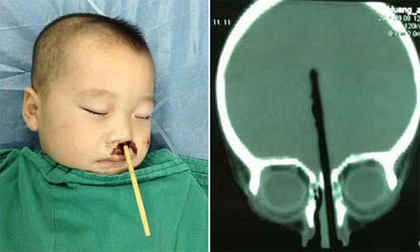TQ: Bé trai 2 tuổi bị đũa chọc từ mũi lên não