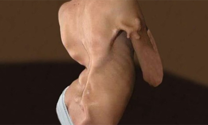 Cô bé Trung Quốc 14 tuổi có cơ thể dần đông cứng như hóa đá