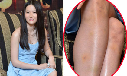 Lưu Diệc Phi lộ đôi chân đầy sẹo và vết bầm tím