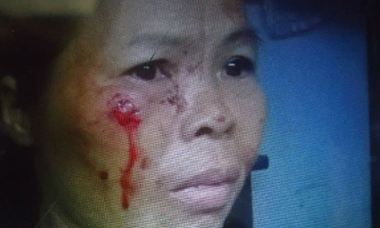 Cháu dâu cắn tai, móc mắt người nhà như 'ma cà rồng' 