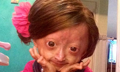 Cuộc sống kỳ lạ của hiện tượng Internet 8 tuổi bị lão hóa