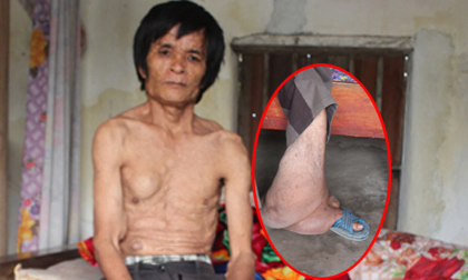 Người đ&#224;n &#244;ng mang khối u nặng 7kg ở ch&#226;n