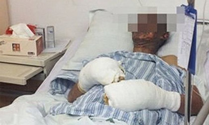 Bị bỏng nặng vì quần áo tích điện gây nổ