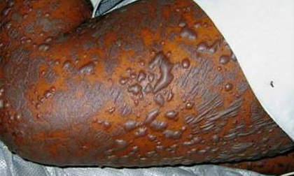 Những biểu hiện dị ứng thuốc nguy hiểm