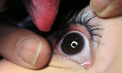 Chữa bệnh về mắt bằng cách… liếm nhãn cầu người bệnh