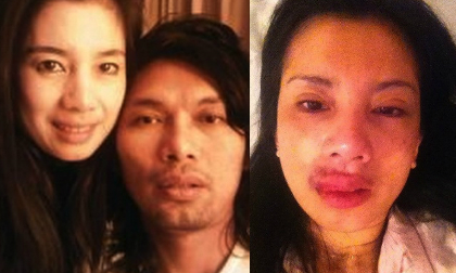 Ca sĩ Thái bị chồng nhạc sĩ đánh đập dã man