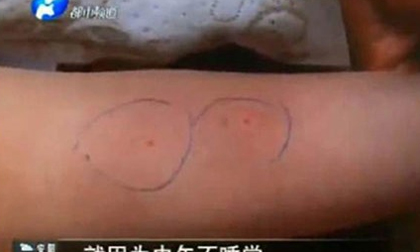 Không ngủ trưa, bé 3 tuổi bị cô giáo mầm non chọc kim vào người