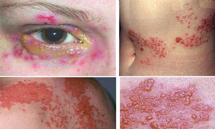 Sốt mò, căn bệnh bị lãng quên đã trở lại