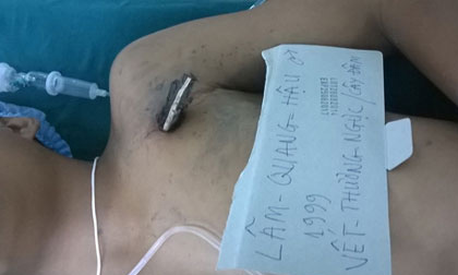 TP.HCM: Một học sinh ngã xuống ao, bị cọc đâm xuyên ngực