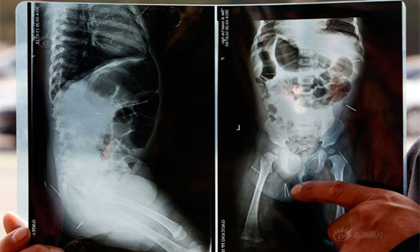 Em bé mọc kim khắp người tại Trung Quốc