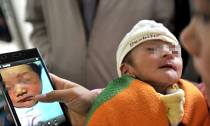 Bé trai 24 tháng tuổi đột ngột biến thành ông lão già nua