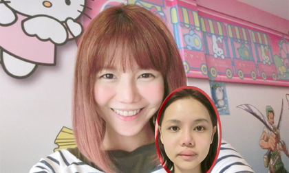 Hot girl Singapore công khai loạt ảnh sưng phù do phẫu thuật thẩm mỹ