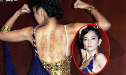 Ella (S.H.E) lộ vết bầm tím đáng sợ khi khoe lưng trần